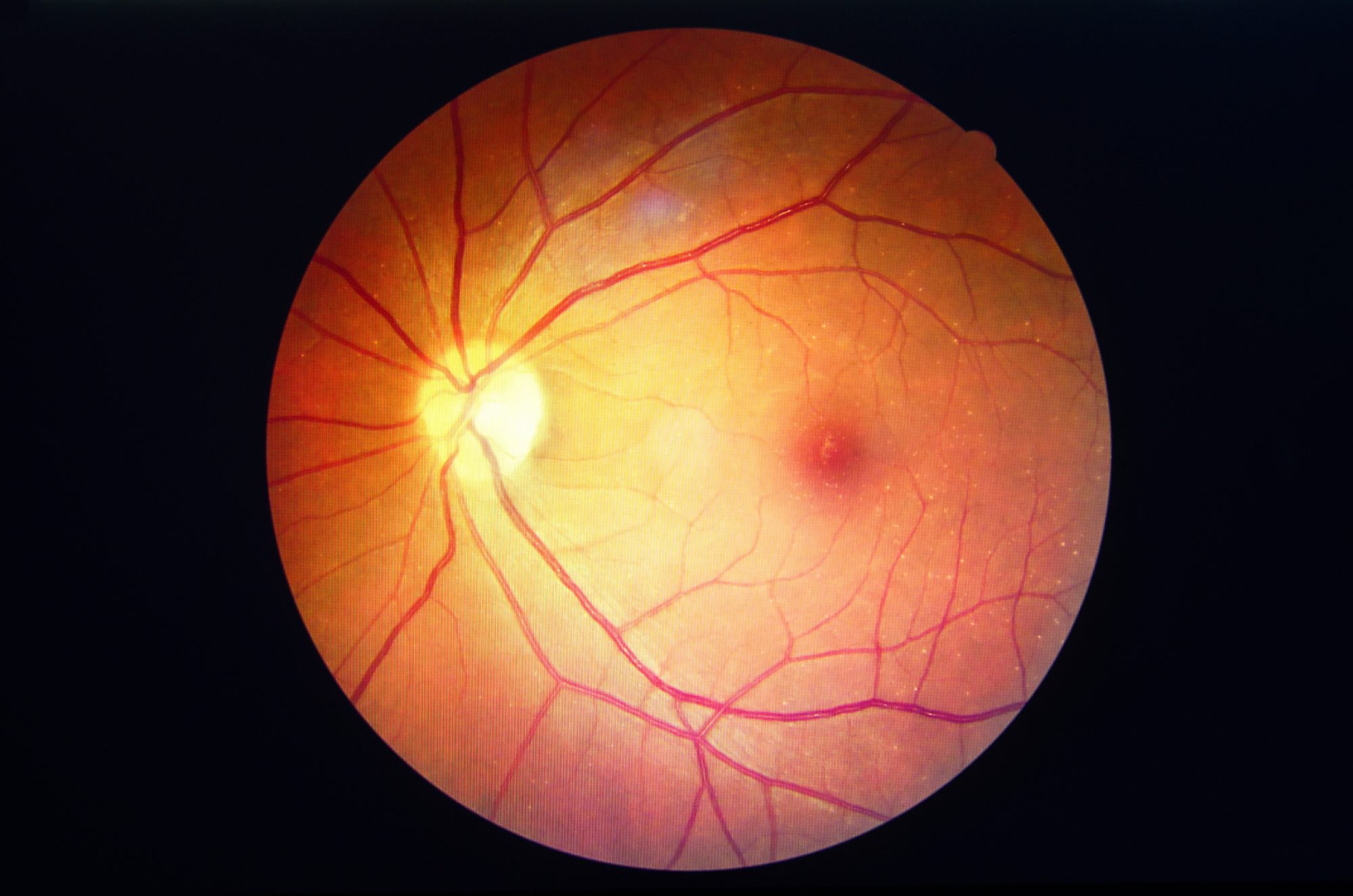 Blindness Detection